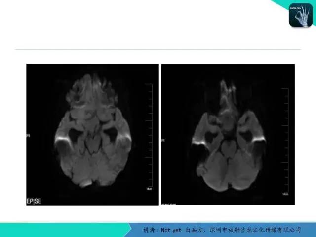 【病例】毛细胞粘液样型星形细胞瘤1例CT及MR影像表现