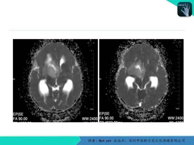 【病例】毛细胞粘液样型星形细胞瘤1例CT及MR影像表现