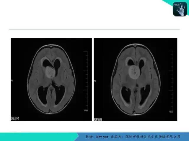 【病例】毛细胞粘液样型星形细胞瘤1例CT及MR影像表现