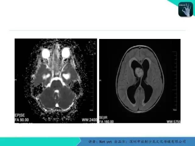 【病例】毛细胞粘液样型星形细胞瘤1例CT及MR影像表现