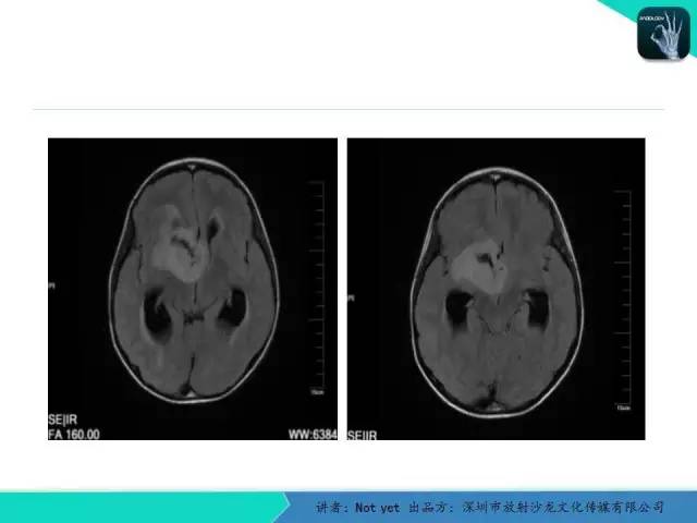 【病例】毛细胞粘液样型星形细胞瘤1例CT及MR影像表现