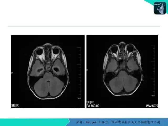 【病例】毛细胞粘液样型星形细胞瘤1例CT及MR影像表现