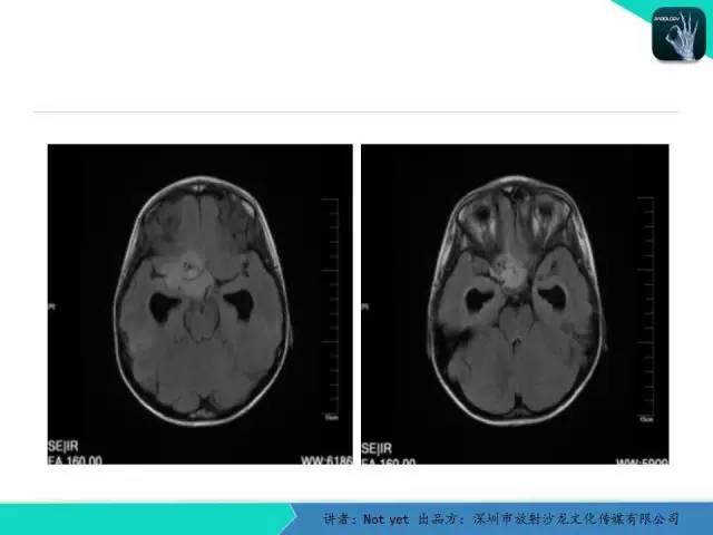 【病例】毛细胞粘液样型星形细胞瘤1例CT及MR影像表现