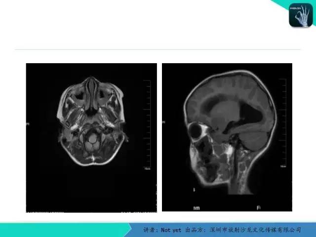 【病例】毛细胞粘液样型星形细胞瘤1例CT及MR影像表现
