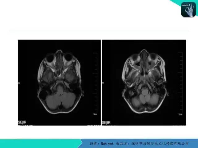 【病例】毛细胞粘液样型星形细胞瘤1例CT及MR影像表现