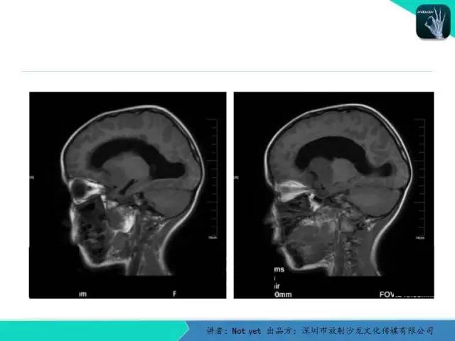 【病例】毛细胞粘液样型星形细胞瘤1例CT及MR影像表现