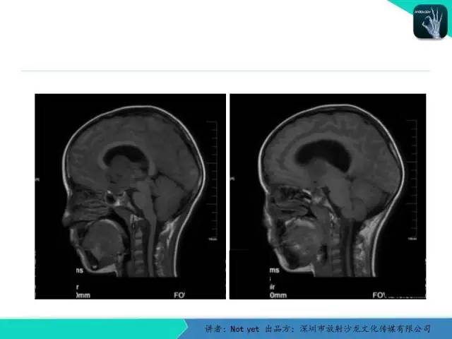 【病例】毛细胞粘液样型星形细胞瘤1例CT及MR影像表现