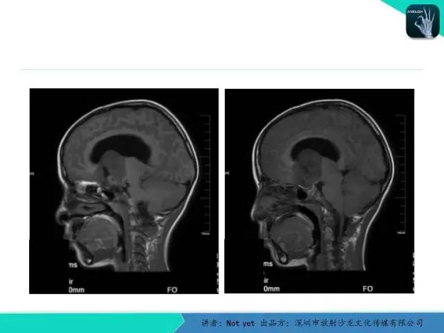 【病例】毛细胞粘液样型星形细胞瘤1例CT及MR影像表现