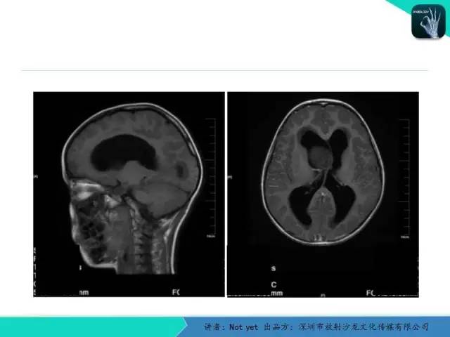 【病例】毛细胞粘液样型星形细胞瘤1例CT及MR影像表现