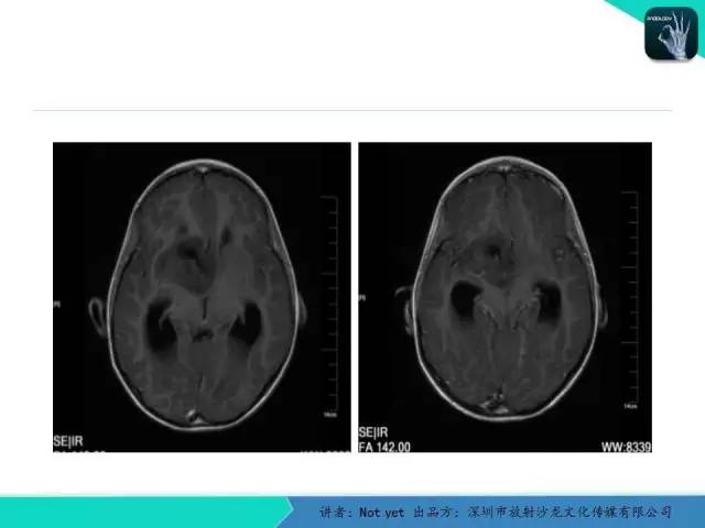 【病例】毛细胞粘液样型星形细胞瘤1例CT及MR影像表现