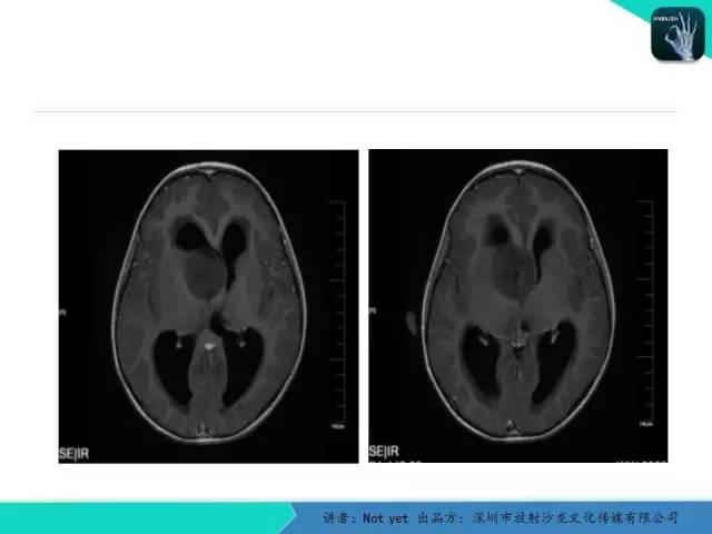 【病例】毛细胞粘液样型星形细胞瘤1例CT及MR影像表现