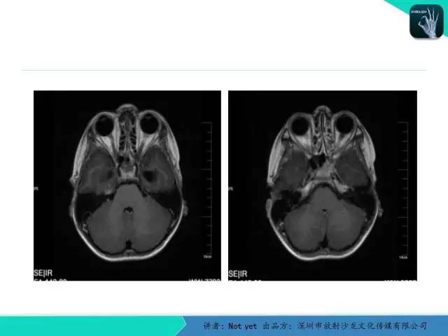 【病例】毛细胞粘液样型星形细胞瘤1例CT及MR影像表现