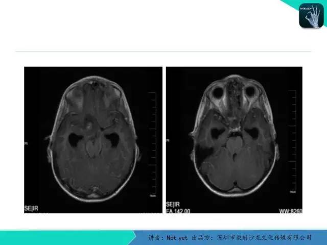 【病例】毛细胞粘液样型星形细胞瘤1例CT及MR影像表现