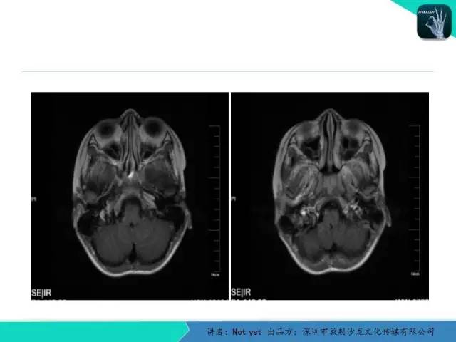 【病例】毛细胞粘液样型星形细胞瘤1例CT及MR影像表现