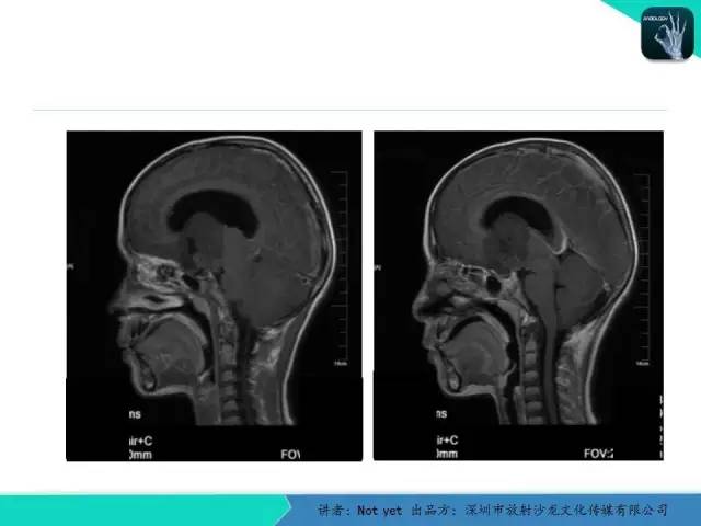 【病例】毛细胞粘液样型星形细胞瘤1例CT及MR影像表现