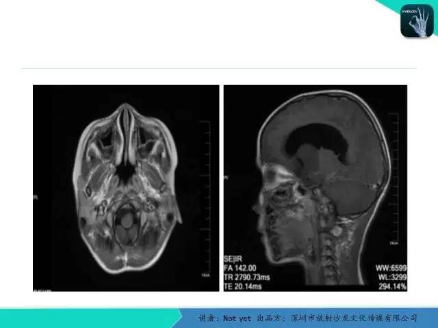 【病例】毛细胞粘液样型星形细胞瘤1例CT及MR影像表现