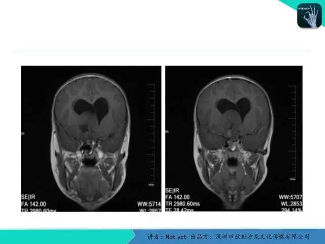 【病例】毛细胞粘液样型星形细胞瘤1例CT及MR影像表现