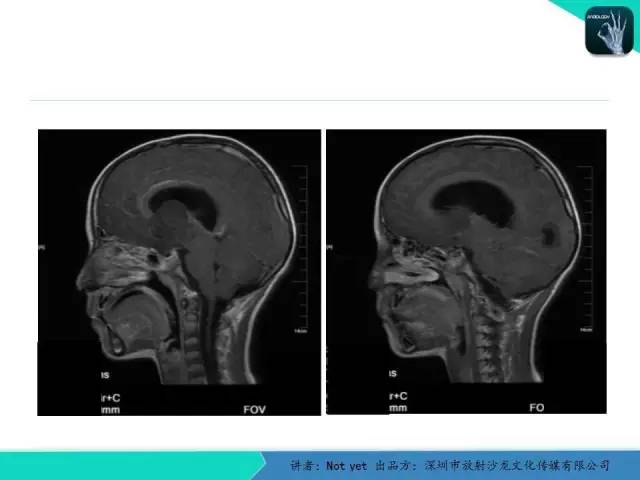 【病例】毛细胞粘液样型星形细胞瘤1例CT及MR影像表现