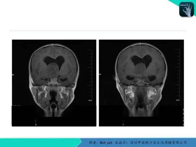 【病例】毛细胞粘液样型星形细胞瘤1例CT及MR影像表现