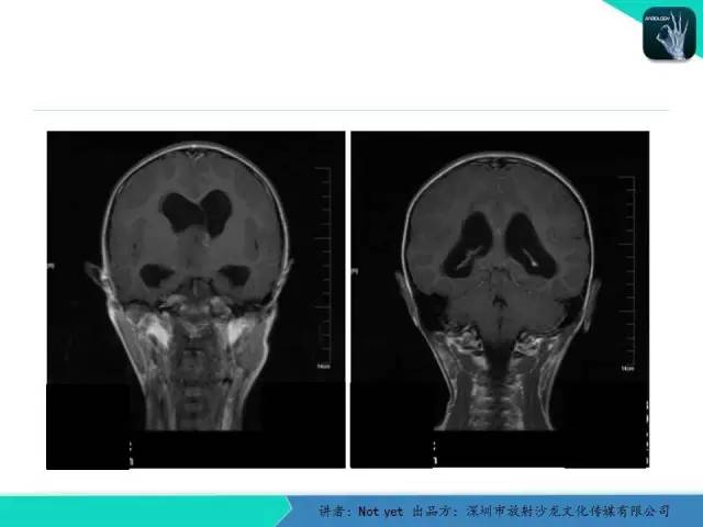 【病例】毛细胞粘液样型星形细胞瘤1例CT及MR影像表现