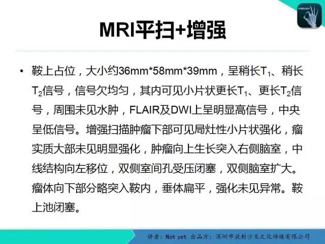 【病例】毛细胞粘液样型星形细胞瘤1例CT及MR影像表现