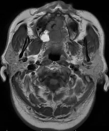 【病例】腭部基底细胞腺瘤1例CT及MR影像表现 【病例】腭部基底细胞腺瘤1例CT及MR影像表现