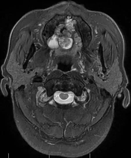 【病例】腭部基底细胞腺瘤1例CT及MR影像表现 【病例】腭部基底细胞腺瘤1例CT及MR影像表现