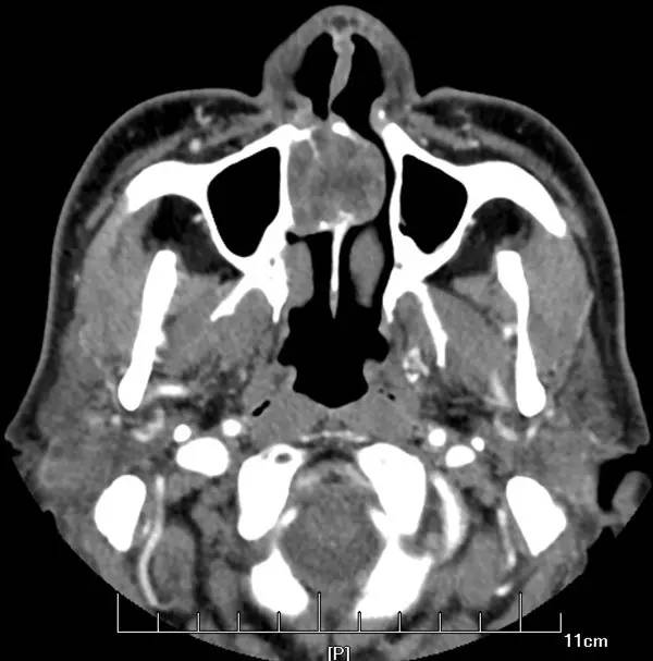 【病例】腭部基底细胞腺瘤1例CT及MR影像表现 【病例】腭部基底细胞腺瘤1例CT及MR影像表现