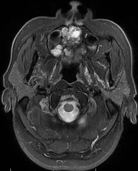 【病例】腭部基底细胞腺瘤1例CT及MR影像表现 【病例】腭部基底细胞腺瘤1例CT及MR影像表现