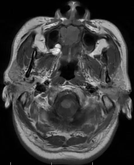 【病例】腭部基底细胞腺瘤1例CT及MR影像表现 【病例】腭部基底细胞腺瘤1例CT及MR影像表现