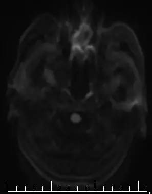 【病例】腭部基底细胞腺瘤1例CT及MR影像表现 【病例】腭部基底细胞腺瘤1例CT及MR影像表现