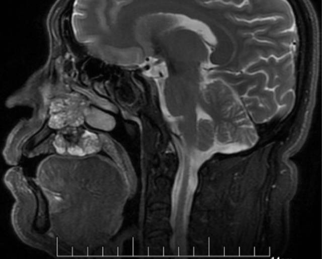 【病例】腭部基底细胞腺瘤1例CT及MR影像表现 【病例】腭部基底细胞腺瘤1例CT及MR影像表现
