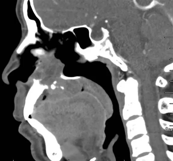 【病例】腭部基底细胞腺瘤1例CT及MR影像表现 【病例】腭部基底细胞腺瘤1例CT及MR影像表现