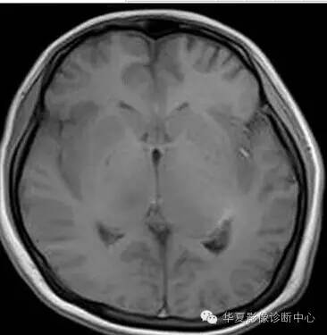 【病例】大脑胶质瘤病1例MR影像表现