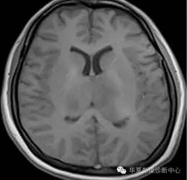 【病例】大脑胶质瘤病1例MR影像表现