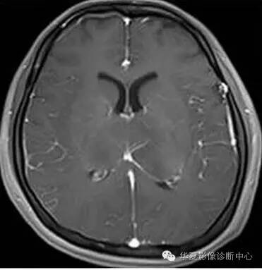 【病例】大脑胶质瘤病1例MR影像表现