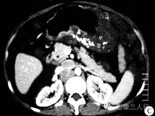 【病例】胃黏液腺癌1例CT影像表现