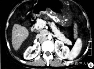 【病例】胃黏液腺癌1例CT影像表现