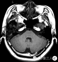 【病例】右颞骨及颅中窝恶性黑色素瘤1例 【病例】右颞骨及颅中窝恶性黑色素瘤1例