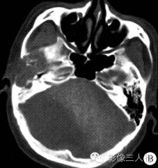 【病例】右颞骨及颅中窝恶性黑色素瘤1例 【病例】右颞骨及颅中窝恶性黑色素瘤1例