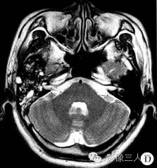 【病例】右颞骨及颅中窝恶性黑色素瘤1例 【病例】右颞骨及颅中窝恶性黑色素瘤1例