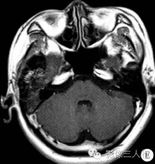 【病例】右颞骨及颅中窝恶性黑色素瘤1例 【病例】右颞骨及颅中窝恶性黑色素瘤1例