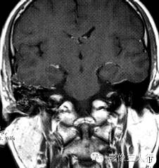 【病例】右颞骨及颅中窝恶性黑色素瘤1例 【病例】右颞骨及颅中窝恶性黑色素瘤1例