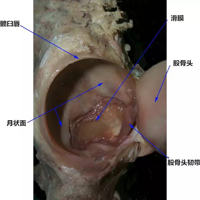 髋关节疼痛之髋臼唇撕裂影像学诊断 髋关节疼痛之髋臼唇撕裂影像学诊断