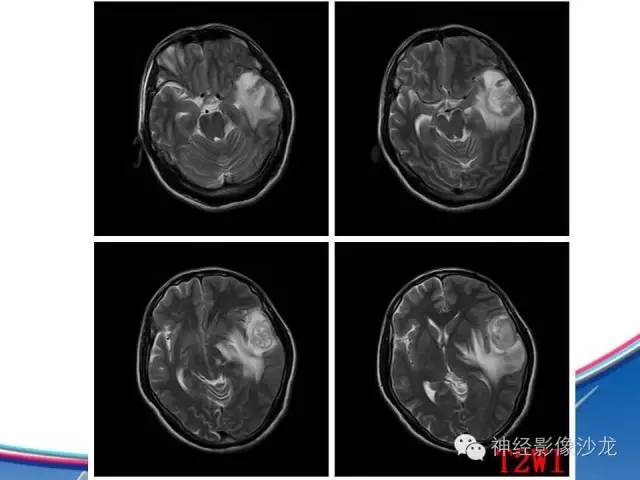 【病例】胶质母细胞瘤1例MR影像表现