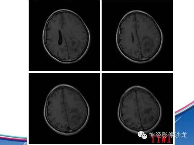 【病例】胶质母细胞瘤1例MR影像表现