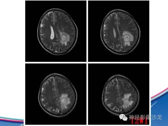 【病例】胶质母细胞瘤1例MR影像表现
