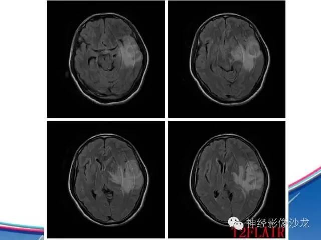 【病例】胶质母细胞瘤1例MR影像表现