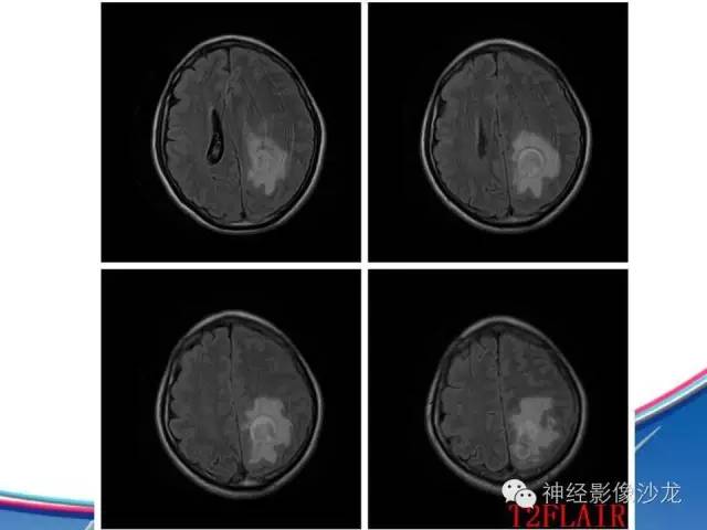 【病例】胶质母细胞瘤1例MR影像表现