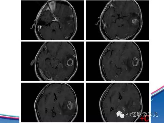 【病例】胶质母细胞瘤1例MR影像表现